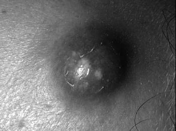 ¿Qué son y por qué aparece el forúnculo nacido o susu´a?