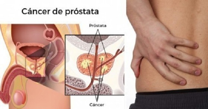 Cáncer de próstata, enfermedad prevenible y con detección temprana es curable