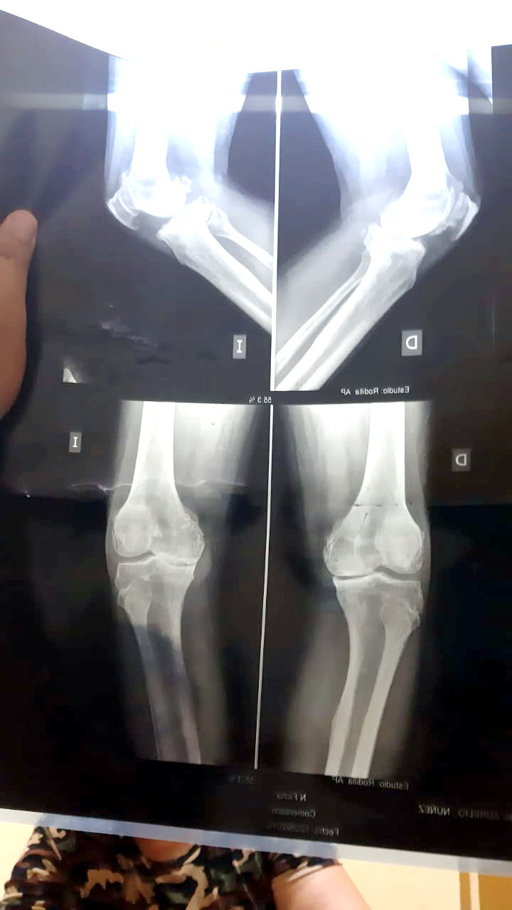 IPS de San Ignacio realiza por primera vez artroplastia total de rodilla