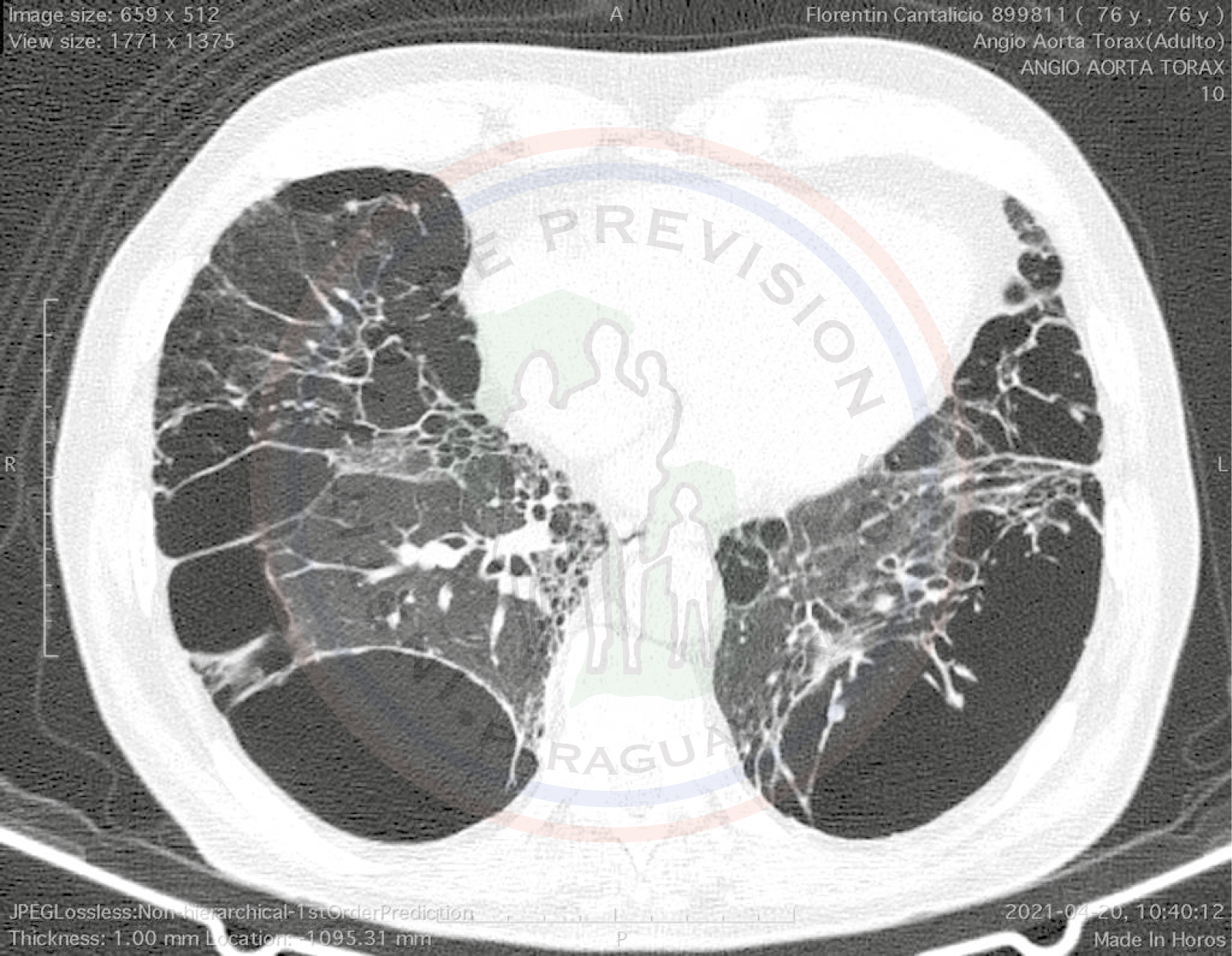 Reparación de aneurisma de aorta abdominal (EVAR) con enfermedad pulmonar severa, exitosa