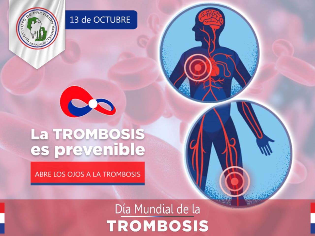 “Día Mundial de la Trombosis”: la trombosis es prevenible, conoce un poco sobre esta enfermedad