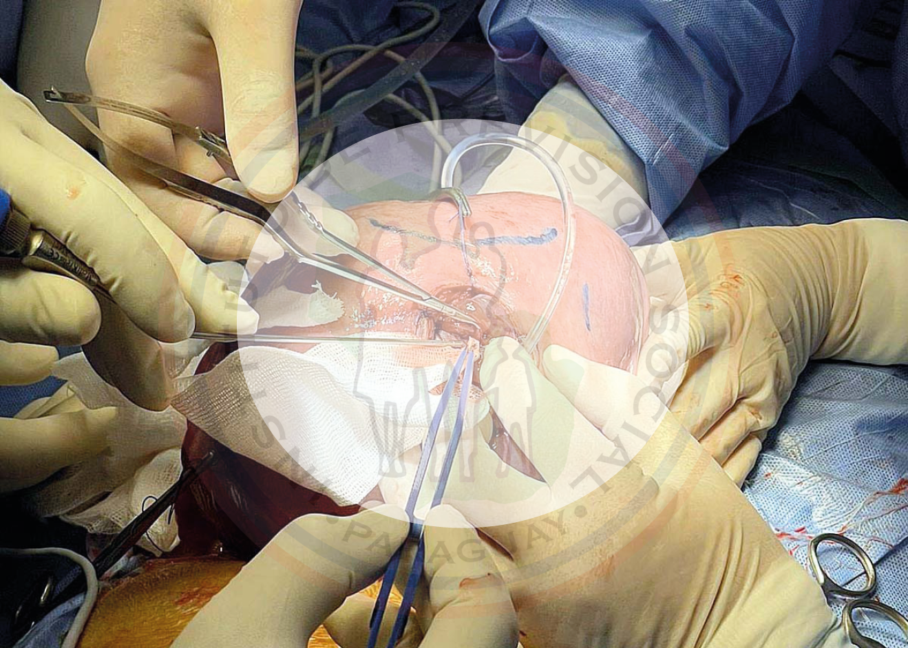 Hospital Central IPS: exitosa sexta cirugía intrauterina a una gestante con 27 semanas
