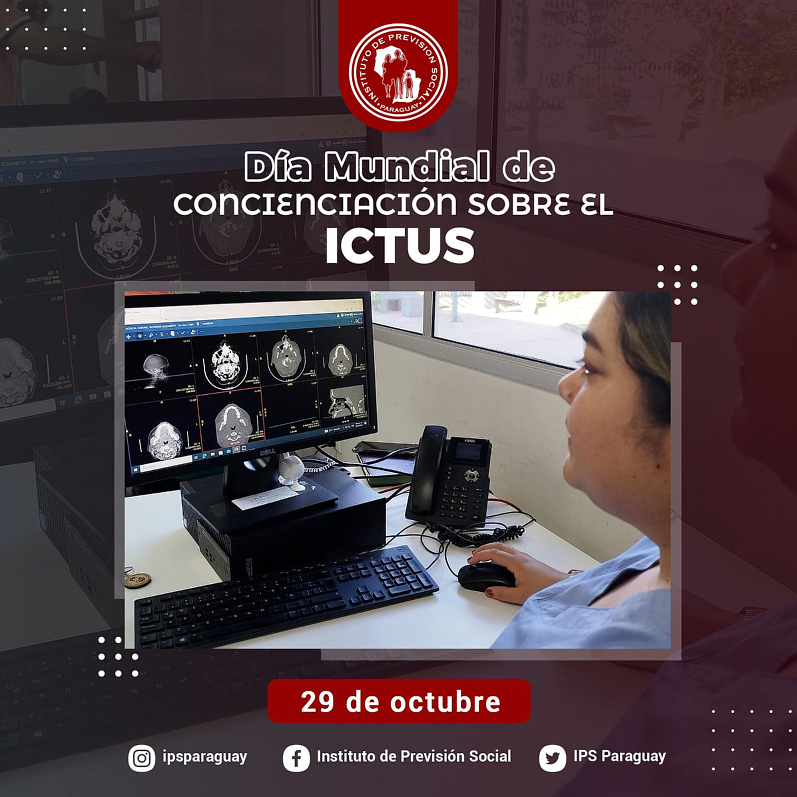 La importancia de la prevención y del tratamiento a tiempo del ataque cerebrovascular para evitar secuelas a futuro