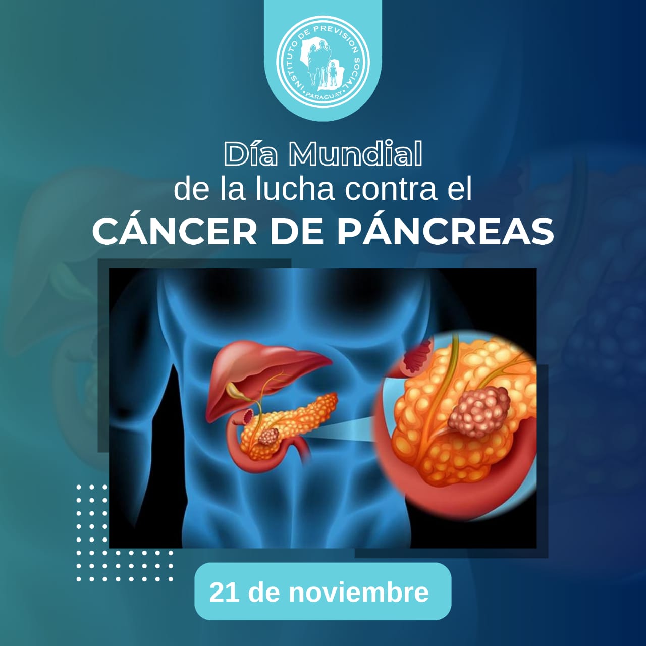 Cáncer de Páncreas: La Urgencia de un Diagnóstico Temprano, para el tratamiento oportuno