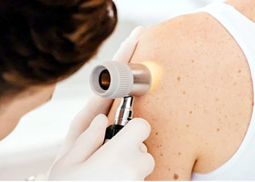 “Conocer la causa del melanoma a tiempo da mayor éxito en el tratamiento”