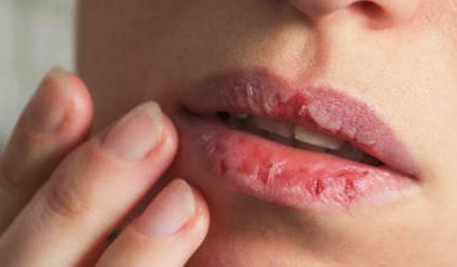 Alguna vez padeciste de labios secos y agrietados en el invierno