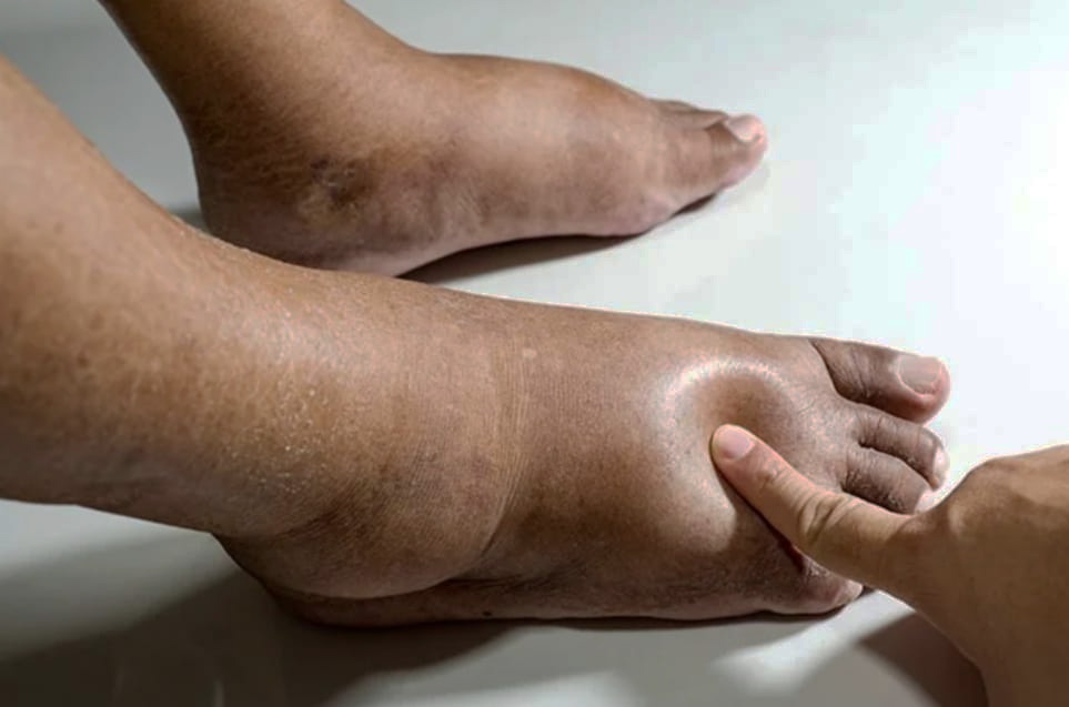 ¿Alguna vez escuchaste hablar sobre la  neuropatía diabética?