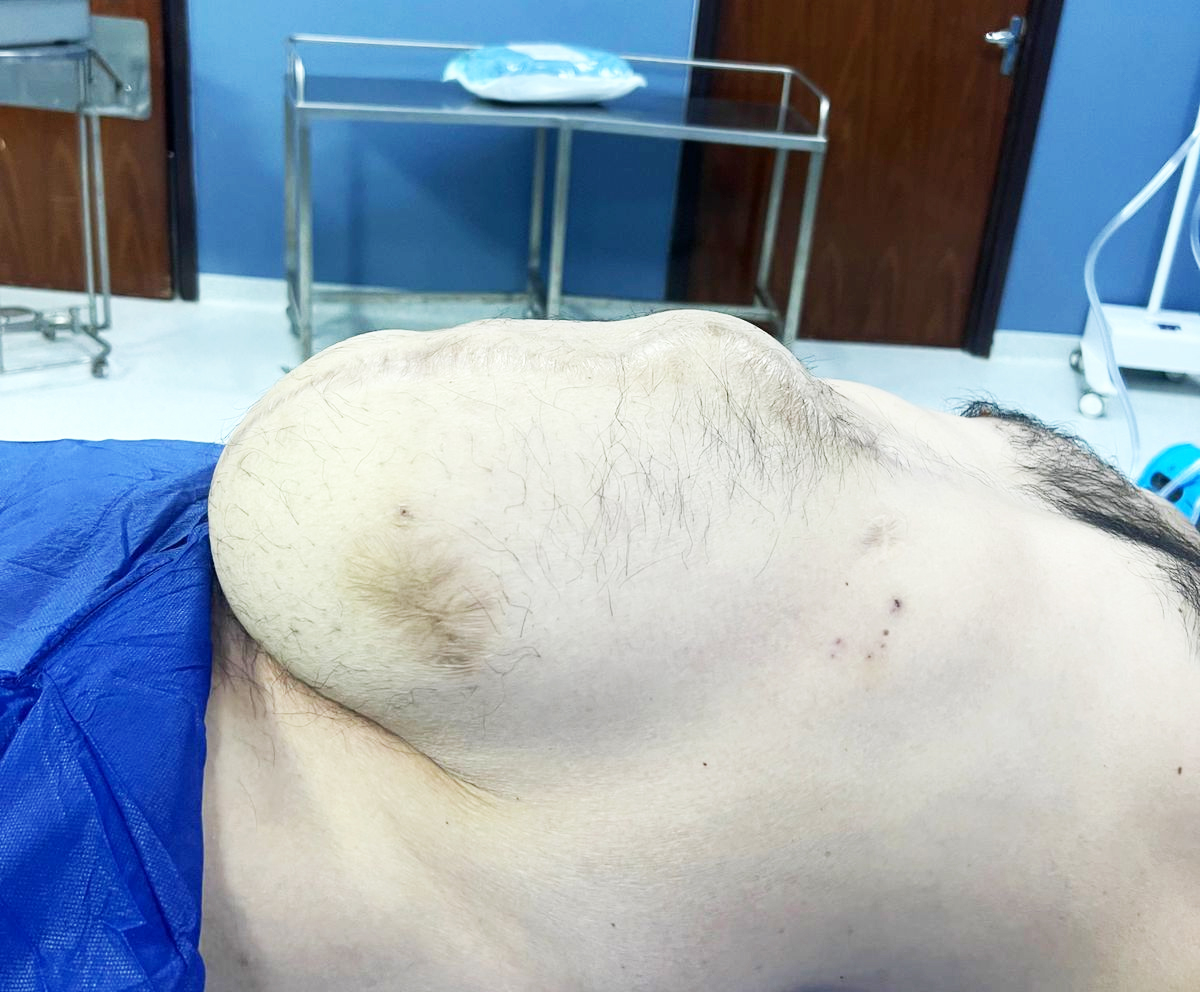 Cirujanos realizan cirugía de 8 horas y reconstruyen el abdomen de paciente con hernia gigante