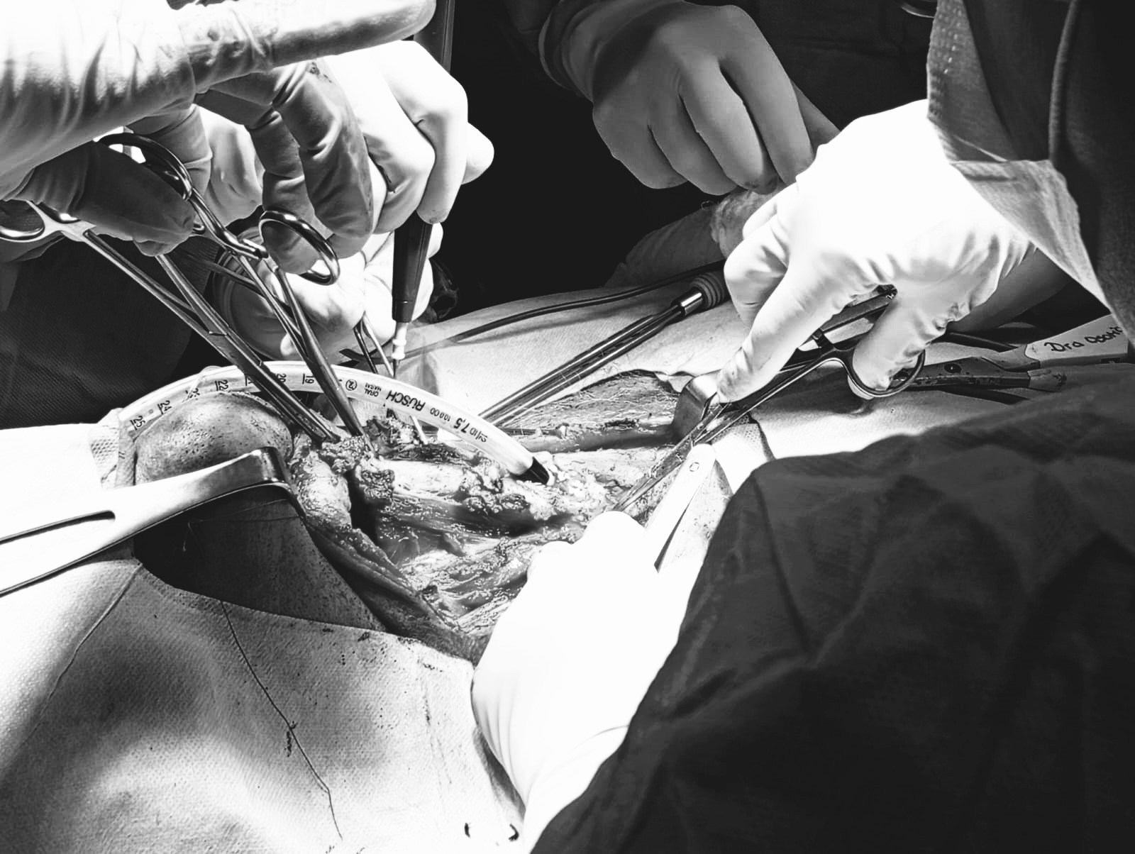 Equipo multidisciplinario de cirujanos del IPS Ingavi realizaron cirugia compleja por sarcoma de laringe