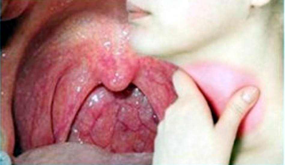 Bultos en el cuello, úlceras en la boca y cambios de voz: síntomas del cáncer de cabeza y cuello