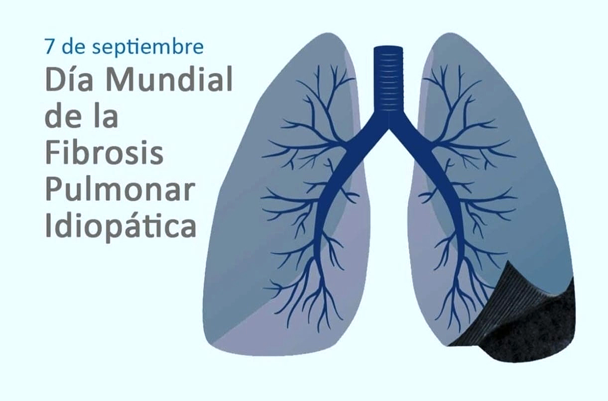 130 pacientes reciben tratamiento por fibrosis pulmonar idiopatica en el Hospital Centrla del IPS