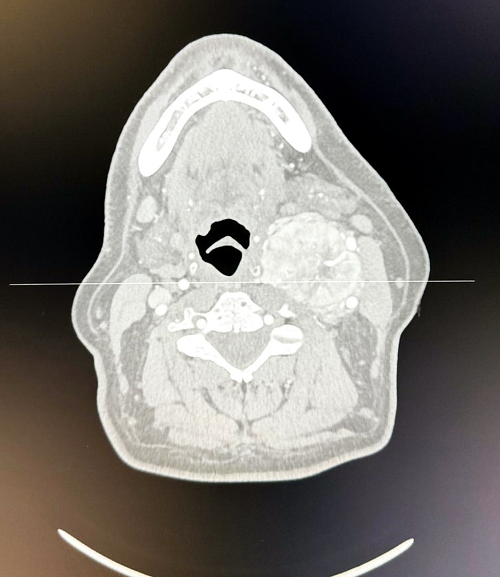 Extraen tumor a paciente con tipo de sangre del 1% de la población