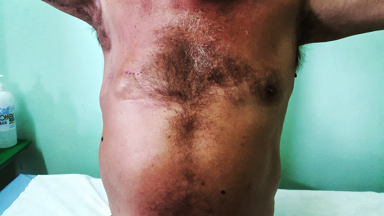 ¿Qué es el cáncer de mama y como se origina? 