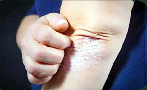 Psoriasis, enfermedad no contagiosa y absolutamente tratable