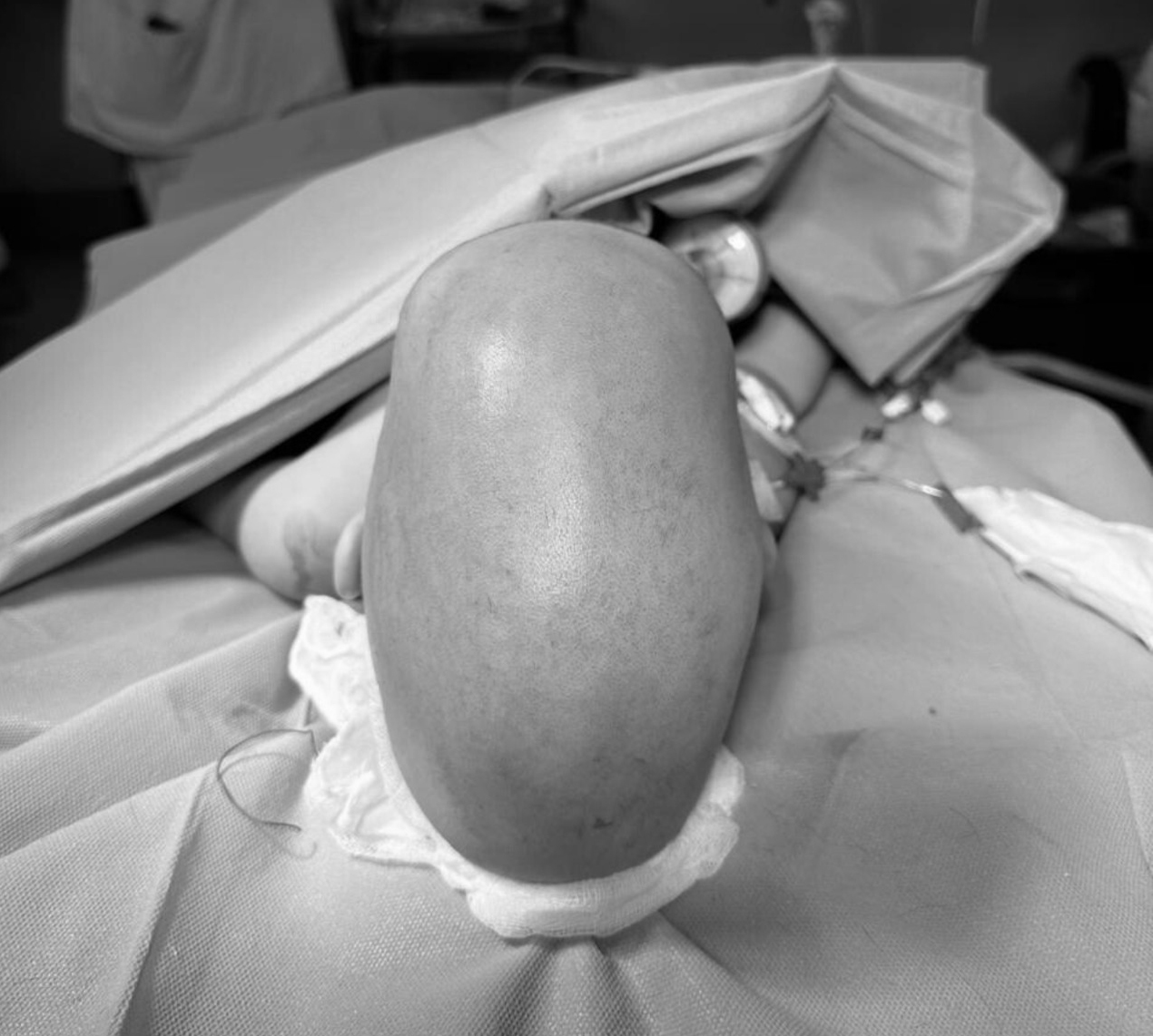 Remodelación craneal completa por escafocefalia en niña de 1 año y 7 meses