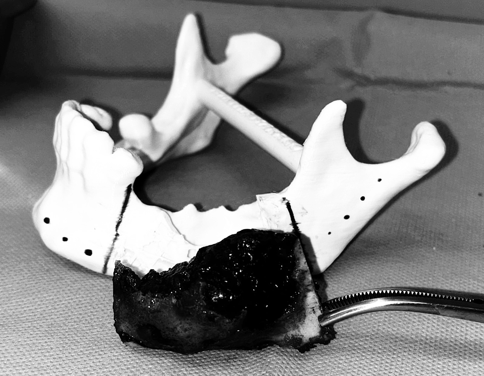 Mediante imágenes tridimensionales, un equipo multidisciplinario realiza una compleja reconstrucción mandibular a paciente