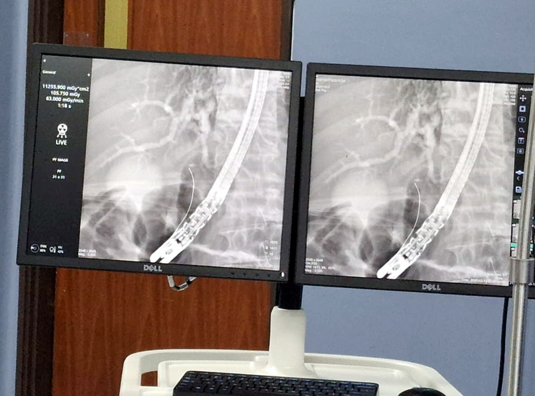 IPS Ingavi incorpora la CPRE como herramienta terapÃ©utica y de diagnÃ³stico  