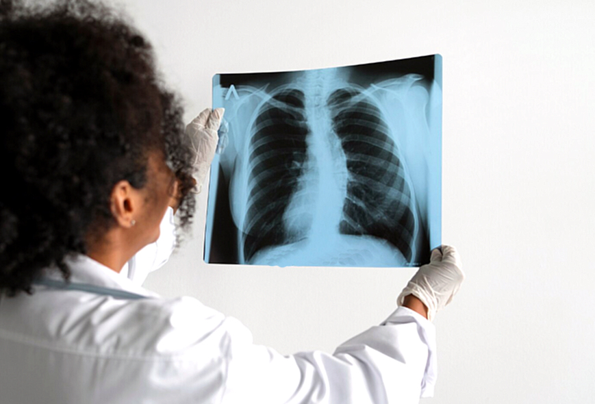 Tuberculosis: destacan el abordaje integral y la coordinación para mejorar la atención