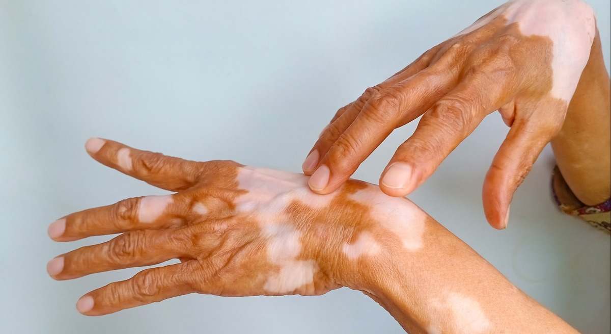 Manchas blancas en la piel: cuándo consultar y por qué el diagnóstico precoz del vitiligo es clave