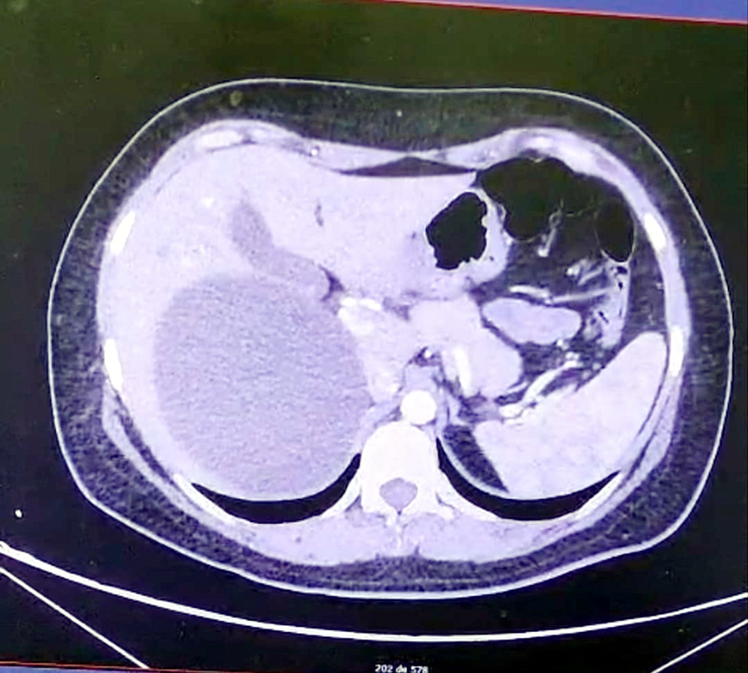 Extirpan por laparoscopía quiste hepático gigante de 14 cm en el Hospital IPS Ingavi