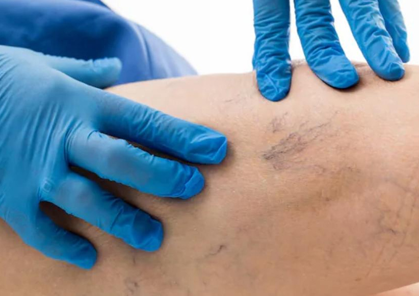 IPS Ingavi incorpora Consultorio de Cirugía Vascular para ampliar la atención especializada