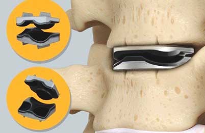 IPS marca un hito mundial al implantar tres discos cervicales artificiales en una misma cirugía