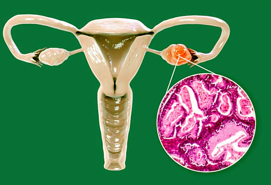 Servicio de ginecología se posiciona como un centro de referencia con un enfoque multidisciplinario y tratamientos especializados para el cáncer de ovario