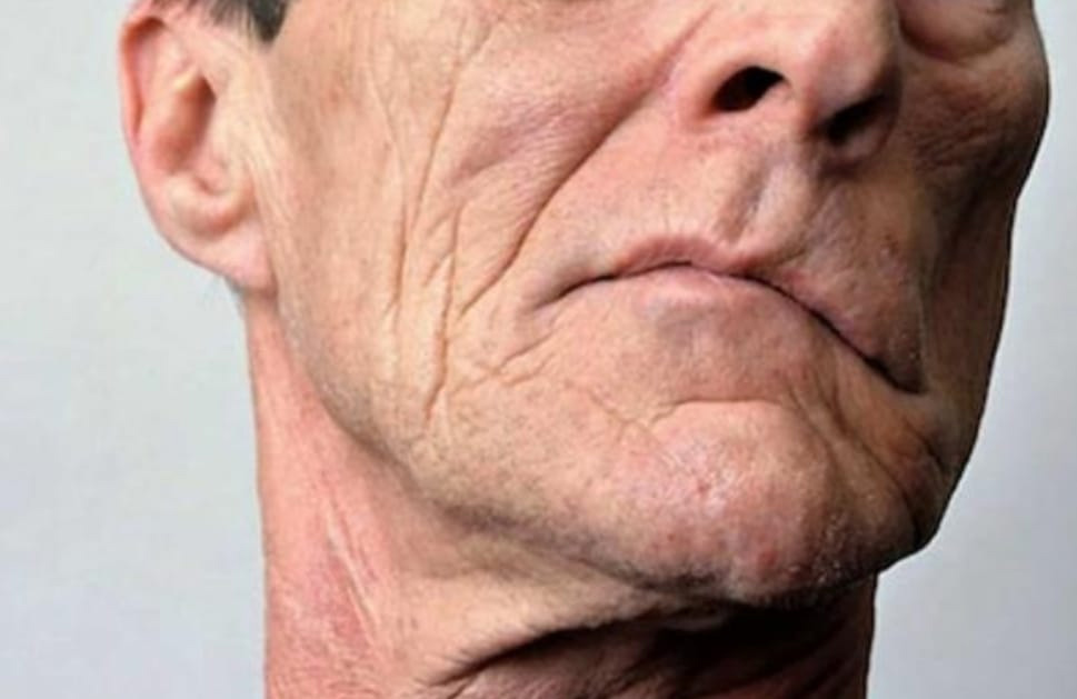 Parálisis facial: la ansiedad que te puede cambiar la cara