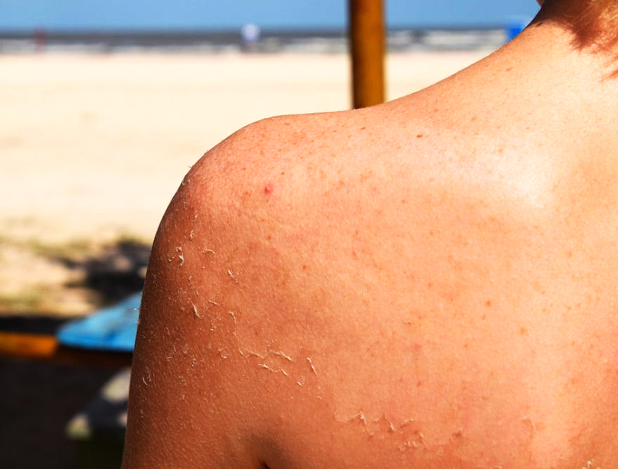 Quemaduras solares un riesgo que no debemos subestimar