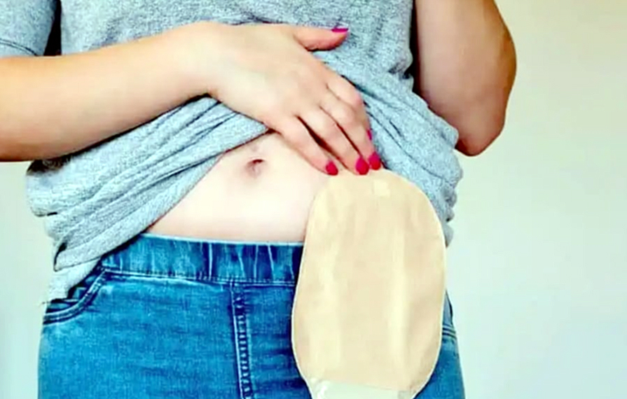 Cuando,¡empieza una nueva vida!’ en el Día Nacional del Ostomizado
