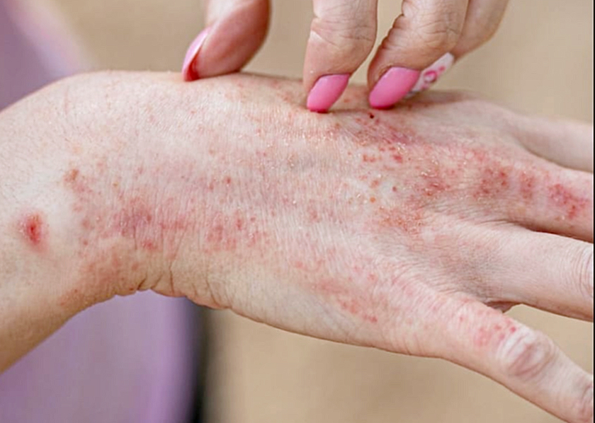 Urticaria Cronica: una picazon en la piel que  puede afectar tu calidad de vida