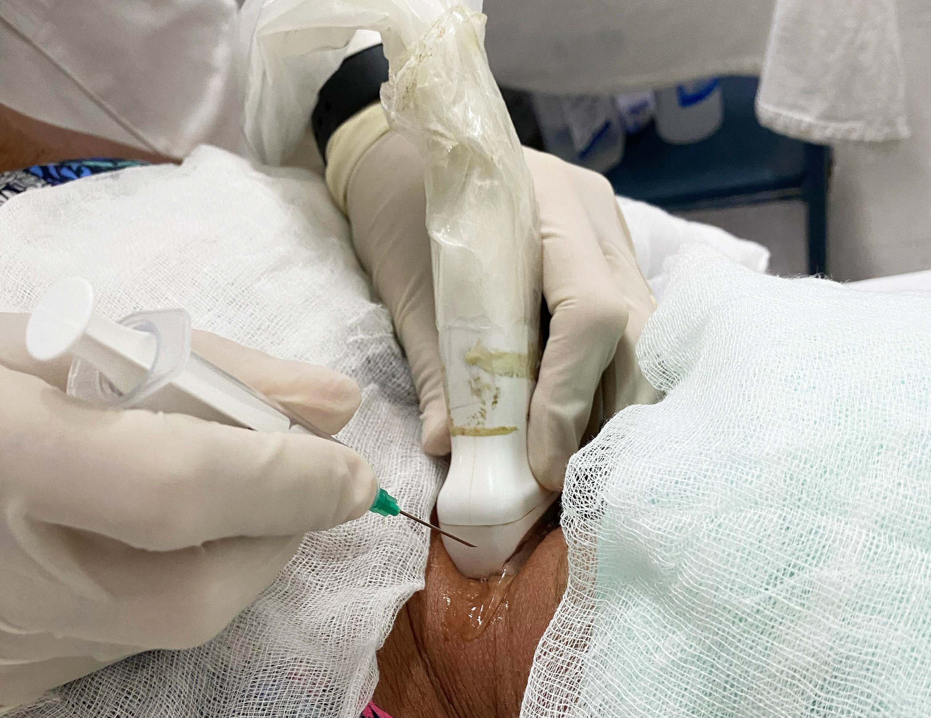 ¿Qué es la Punción con aguja fina de Tiroides bajo guía Ecográfica?