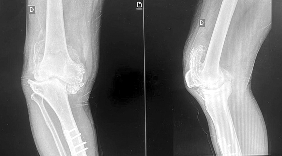 Paciente de 52 aÃ±os recupera su calidad de vida tras una cirugÃ­a compleja de rodilla en el Hospital Central