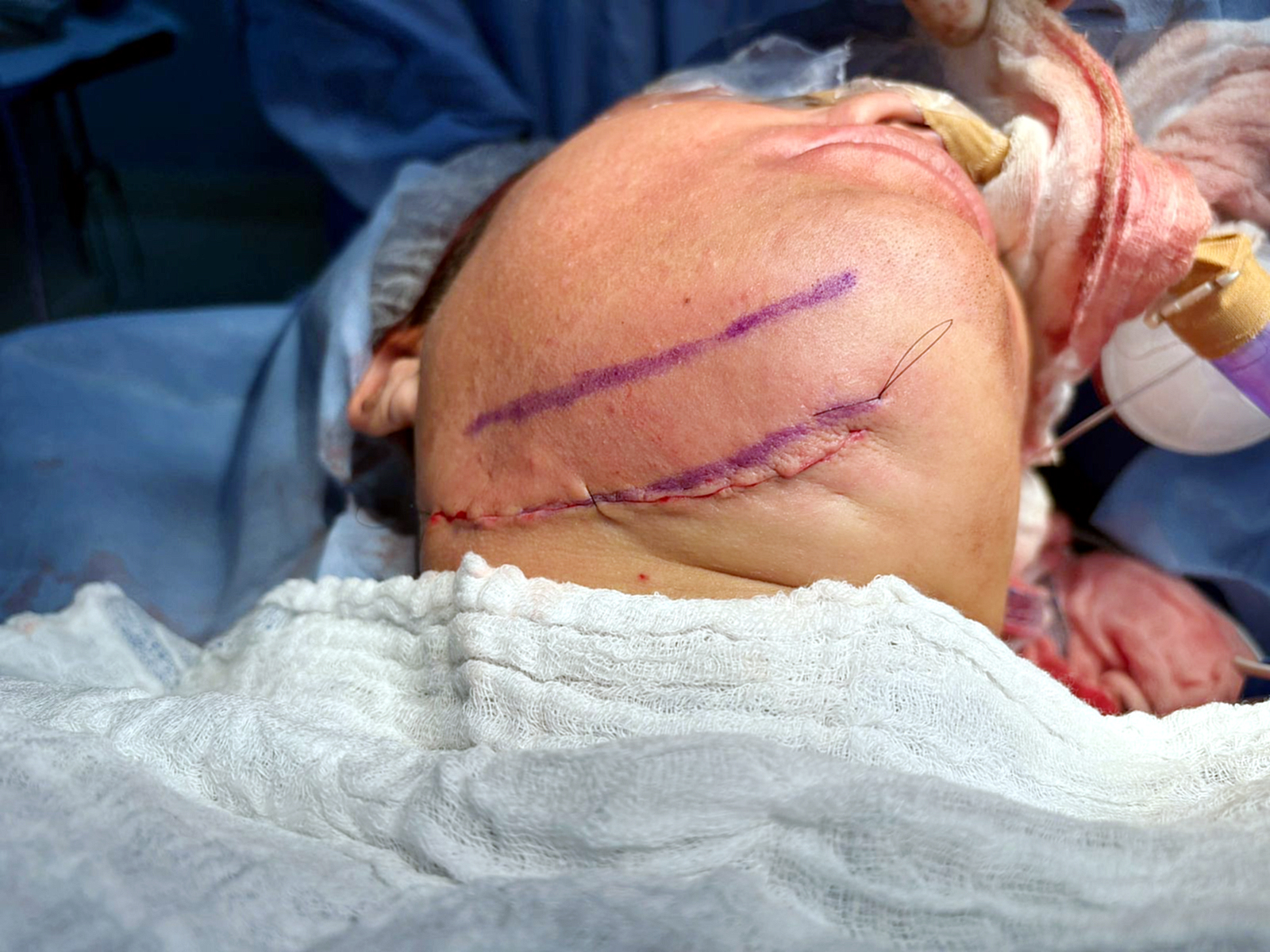 Un regalo de Navidad: exitoso procedimiento quirÃºrgico maxilofacial en el Hospital Central del IPS