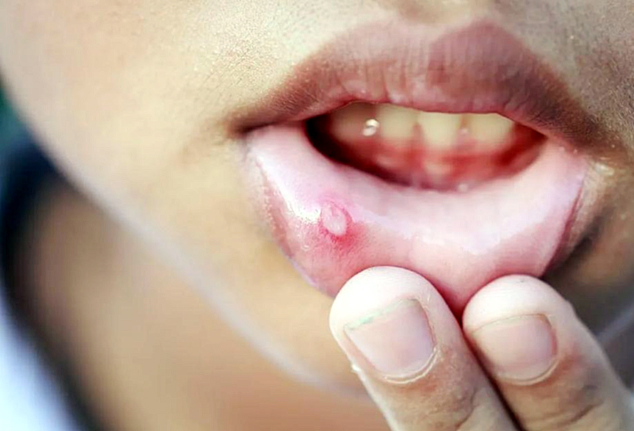 Herpes labial en niños: síntomas, contagio y cuándo acudir al pediatra