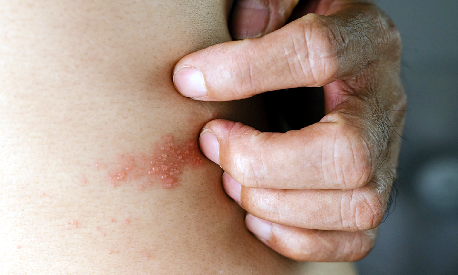 “Fuego de San Antonio”: claves para detectar a tiempo el herpes zóster y evitar complicaciones graves