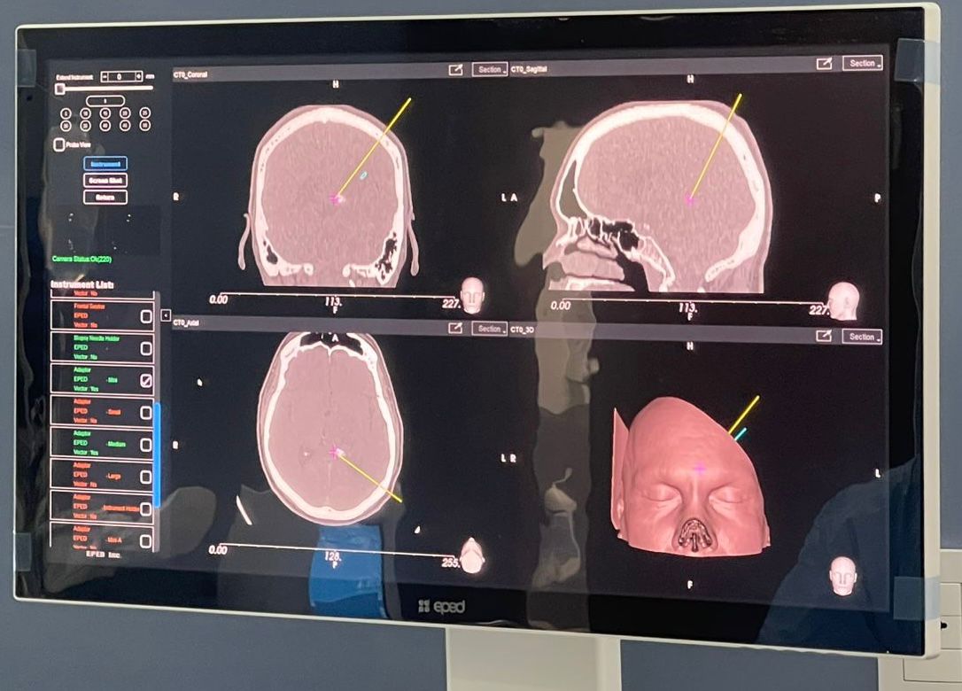 IPS Ingavi incorpora su primer neuronavegador y realiza exitosamente las primeras cirugías asistidas con esta tecnología