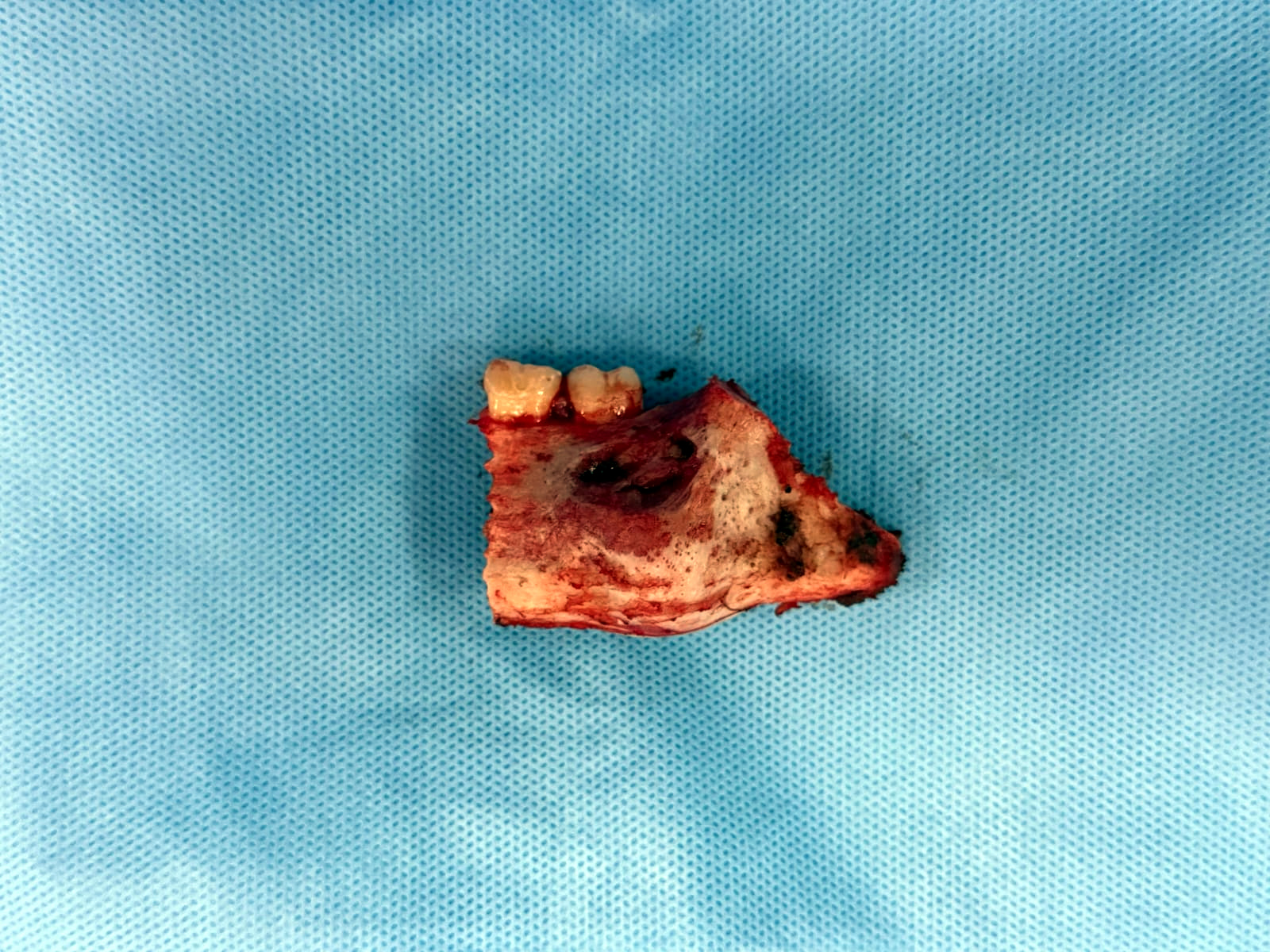 IPS Ingavi realiza compleja cirugía reconstructiva de mandíbula a paciente con displasia fibrosa