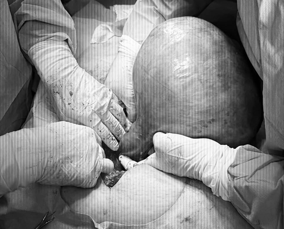 Cirugía multidisciplinaria permite extracción de un tumor de importante tamaño