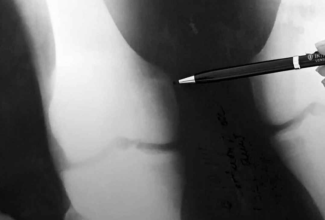 Osteoporosis: detectar los riesgos a tiempo ayuda a prevenir fracturas